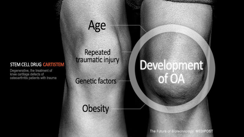 stem cell treatment for knee cartilage stem cell treatment for knee cartilage